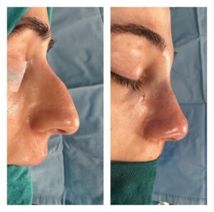 Ρινοπλαστική 6 ρινοπλαστική