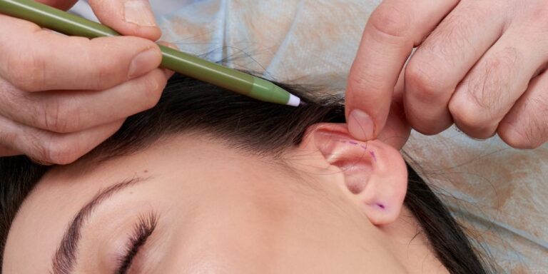 Ωτοπλαστική