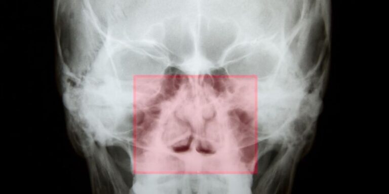 στραβό ρινικό διάφραγμα