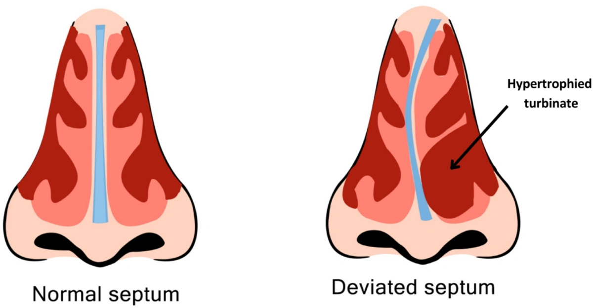 Σκολίωση ρινικού διαφράγματος