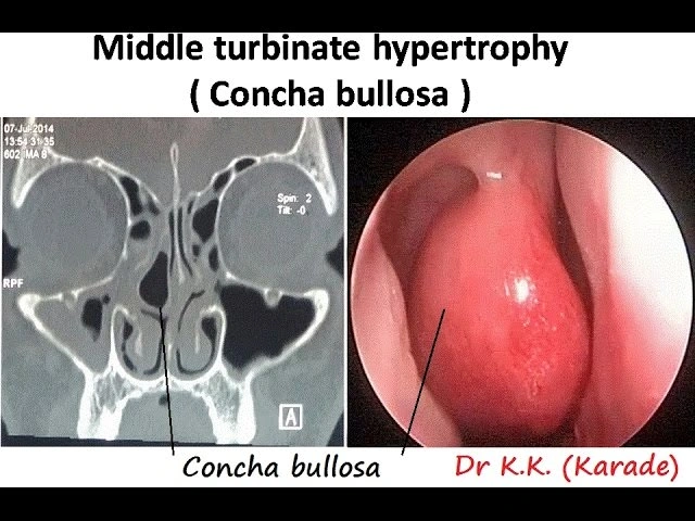 Υπερτροφία ρινικών κογχών